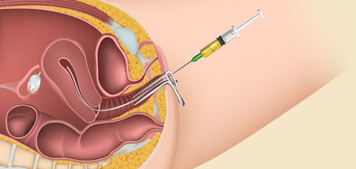 INSEMINAÇÃO INTRAUTERINA (IIU)